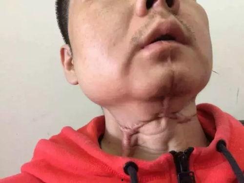 吃口瓜突然舌头难受